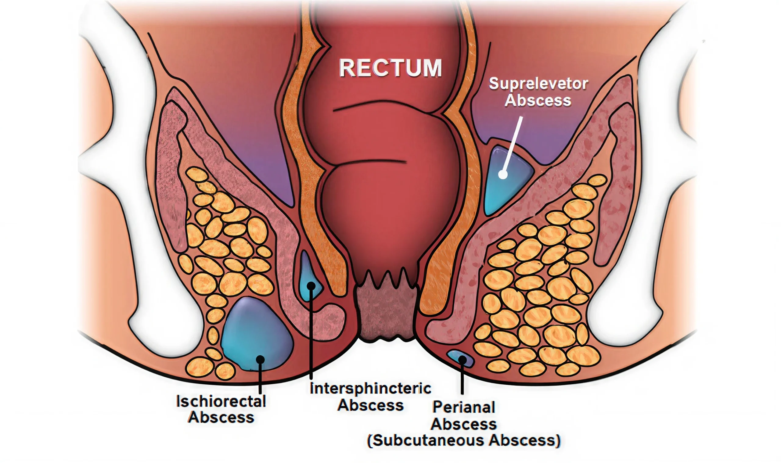 Anal Fistula Clinical View
