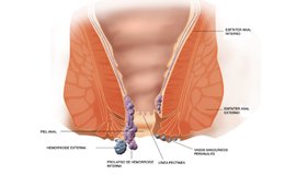 Hemorrhoids