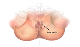 Anal Warts